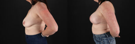 Breast Lift with Implants case #7897