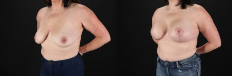 Breast Lift with Implants case #7897