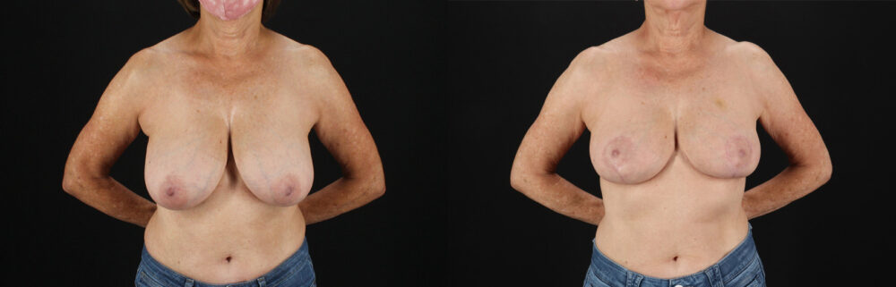 Breast Reduction case #8012