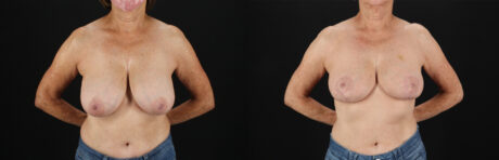 Breast Reduction case #8012