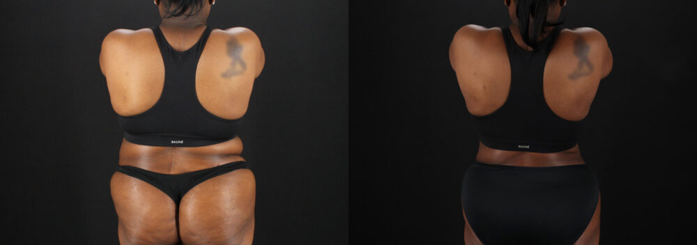 Liposuction case #6122