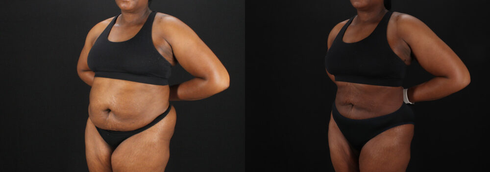 Liposuction case #6122