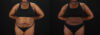 Liposuction case #6122 slider thumbnail