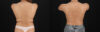 Breast Augmentation case #6462 slider thumbnail