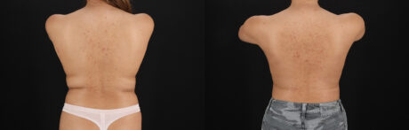 Breast Augmentation case #6462