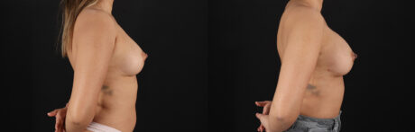 Breast Augmentation case #6462