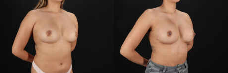 Breast Augmentation case #6462