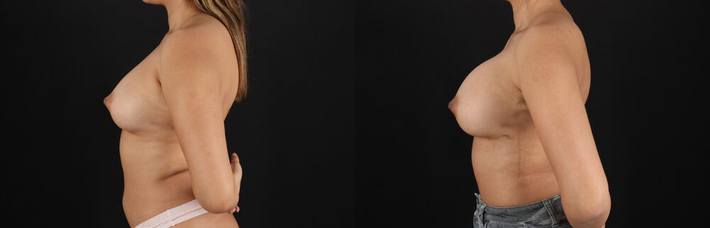 Breast Augmentation case #6462