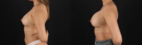 Breast Augmentation case #6462
