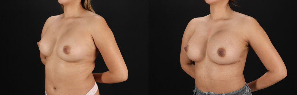 Breast Augmentation case #6462