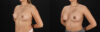 Breast Augmentation case #6462 slider thumbnail