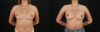 Breast Augmentation case #6462 slider thumbnail