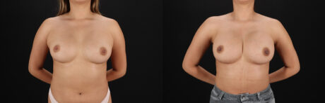 Breast Augmentation case #6462