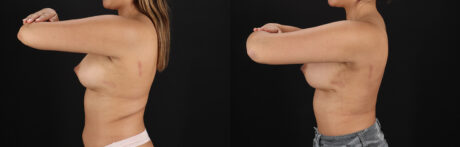 Breast Augmentation case #6462