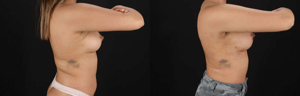 Breast Augmentation case #6462