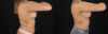Breast Augmentation case #6462 slider thumbnail