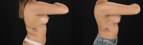 Breast Augmentation case #6462