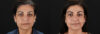 Cosmelan Chemical Peel case #5087 slider thumbnail