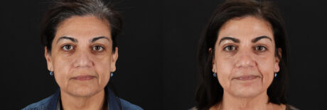 Cosmelan Chemical Peel case #5087