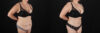 Tummy Tuck case #7627 slider thumbnail