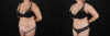 Tummy Tuck case #7627 slider thumbnail