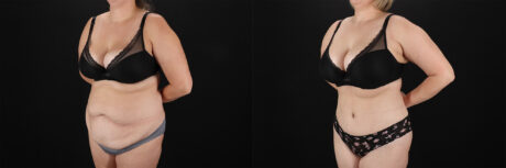 Tummy Tuck case #7627