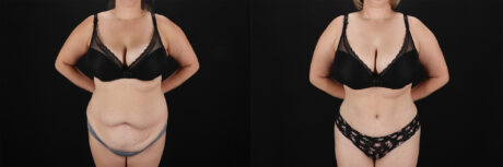 Tummy Tuck case #7627