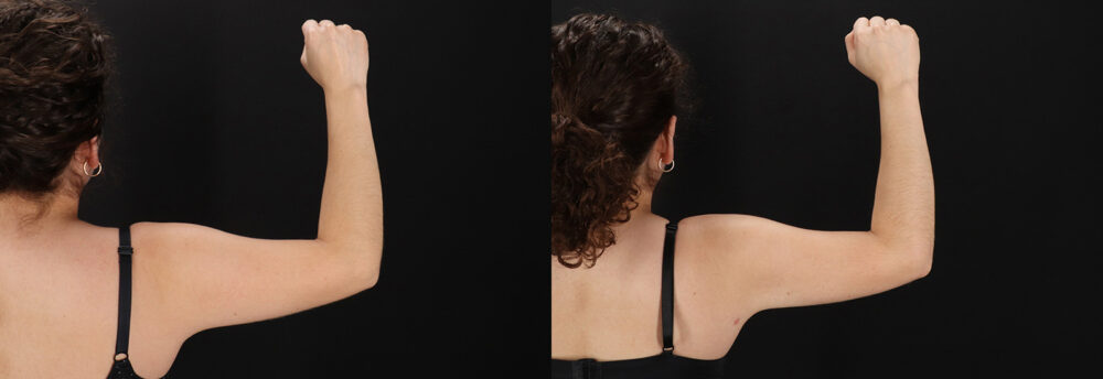 Brazilian Butt Lift case #5457