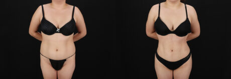 Brazilian Butt Lift case #5457