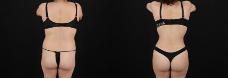 Brazilian Butt Lift case #5457