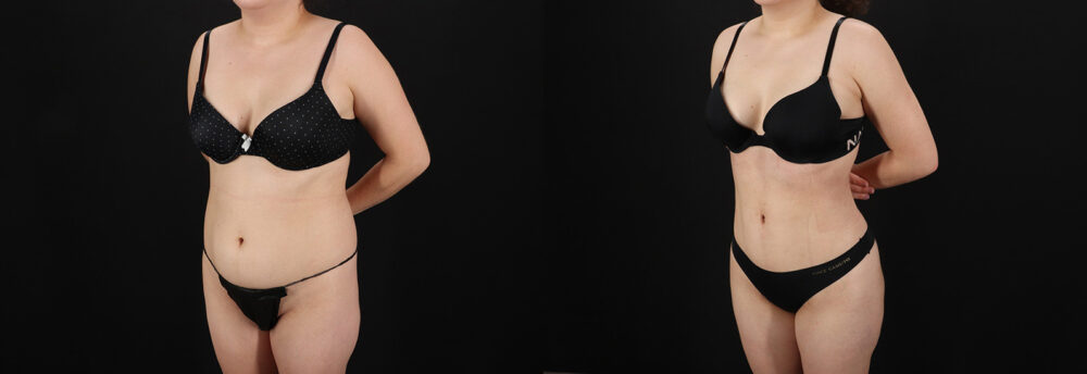 Brazilian Butt Lift case #5457