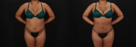 Brazilian Butt Lift case #5458