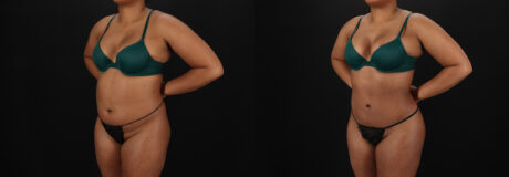 Brazilian Butt Lift case #5458