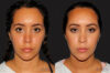 Submental Liposuction case #6943 slider thumbnail
