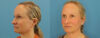 Profound RF Skin Tightening case #6906 slider thumbnail