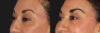 Blepharoplasty case #6888 slider thumbnail