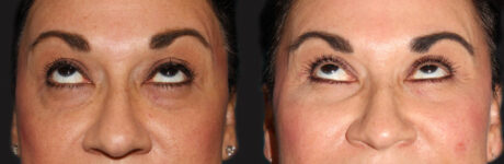 Blepharoplasty case #6888