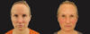 Profound RF Skin Tightening case #6906 slider thumbnail