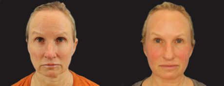 Profound RF Skin Tightening case #6906