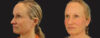 Profound RF Skin Tightening case #6906 slider thumbnail