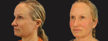 Profound RF Skin Tightening case #6906