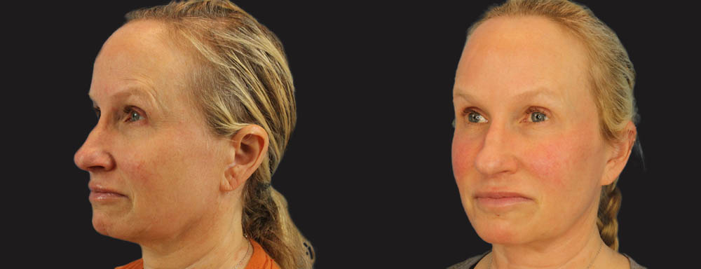 Profound RF Skin Tightening case #6906