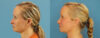 Profound RF Skin Tightening case #6906 slider thumbnail