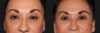 Blepharoplasty case #6888 slider thumbnail