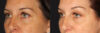 Blepharoplasty case #6890 slider thumbnail