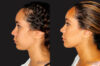 Submental Liposuction case #6943 slider thumbnail