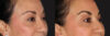 Blepharoplasty case #6888 slider thumbnail