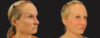 Profound RF Skin Tightening case #6906 slider thumbnail