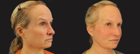 Profound RF Skin Tightening case #6906
