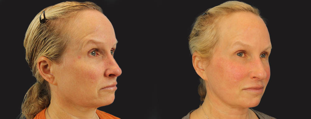Profound RF Skin Tightening case #6906